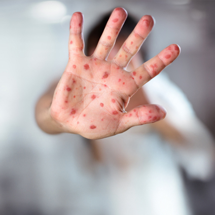 Measles